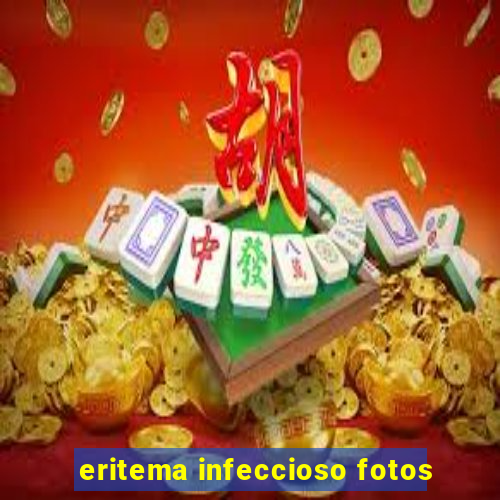 eritema infeccioso fotos